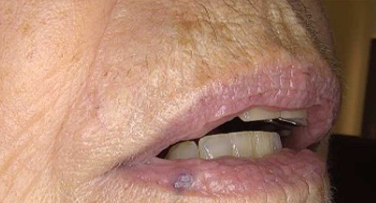 Hair removal (upper lip-chin)
