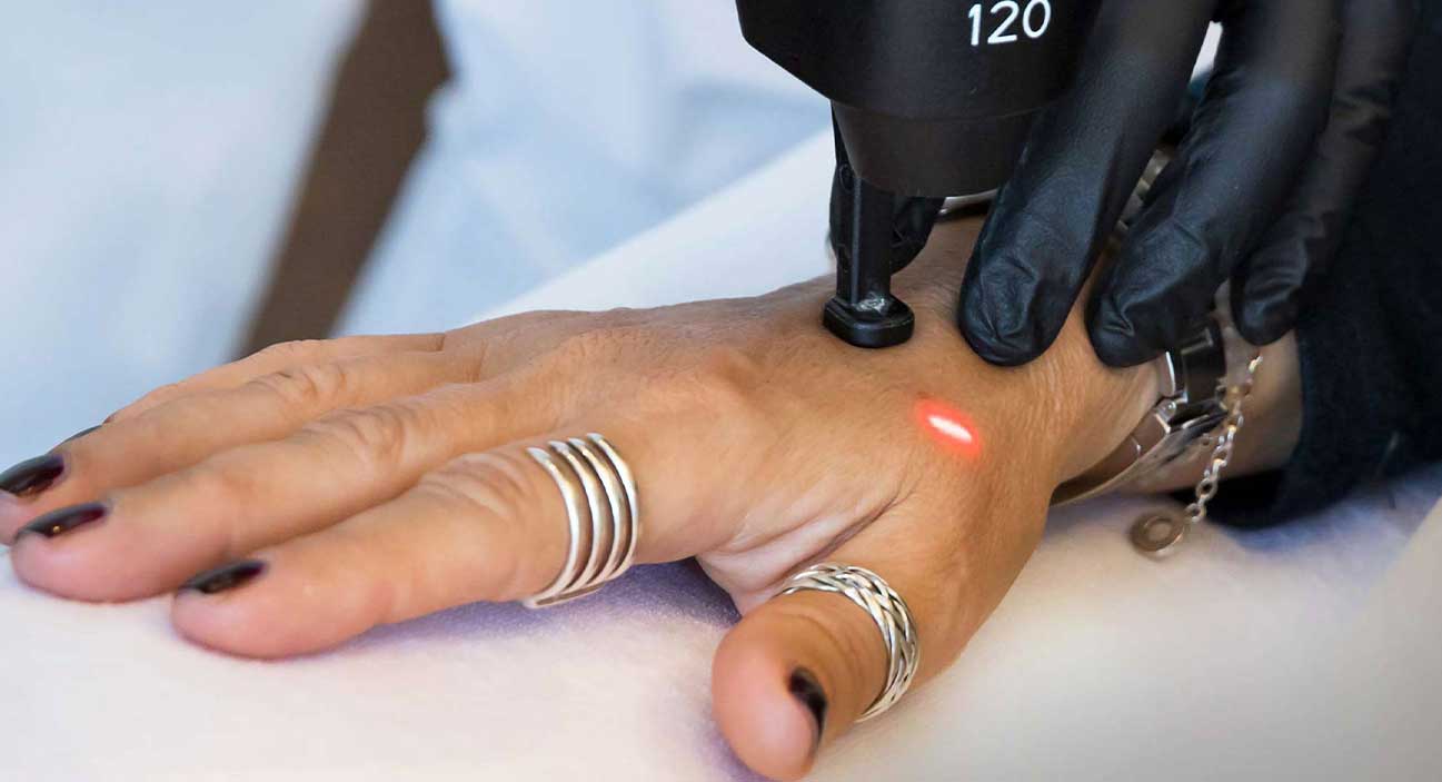 Laserbehandlung - CO2 Laser/LaseMD für Hautverjüngung
