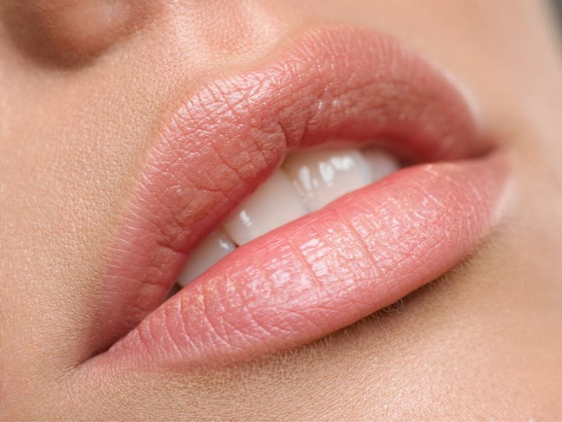  Removal of PMU lip (upper or lower lip)