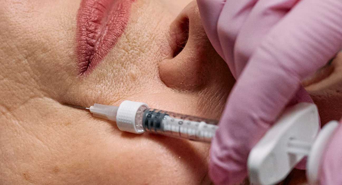 Treatment of nasolabial folds