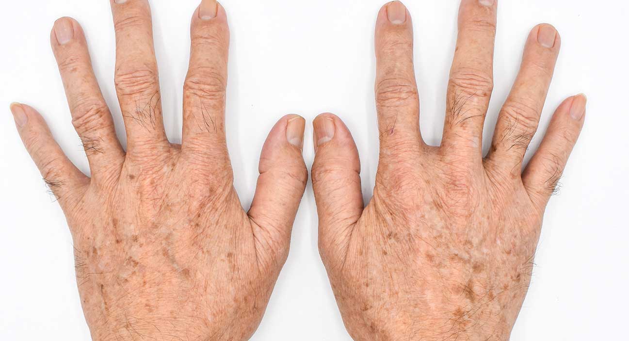  Age wart removal