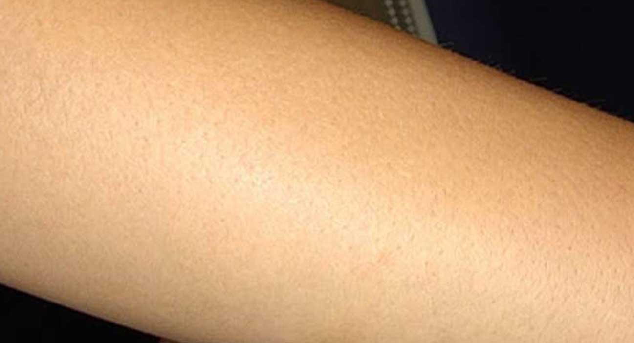  Hair removal (arms)